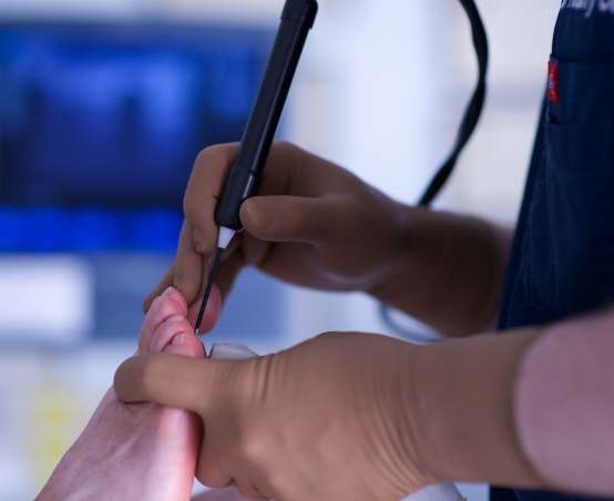 Large view of morton's neuroma being treated by cryosurgery